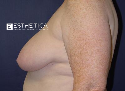 Breast Lift Before & After Patient #3472