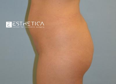 Liposuction Before & After Patient #3613