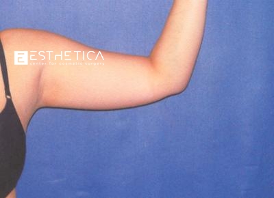 Liposuction Before & After Patient #3742
