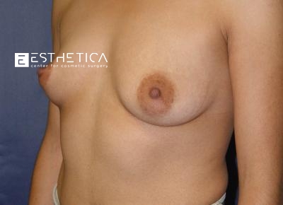 Breast Augmentation Before & After Patient #3328