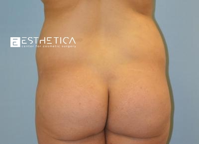 Liposuction Before & After Patient #3620