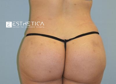 Liposuction Before & After Patient #3620