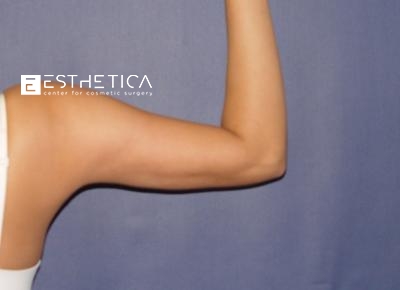 Liposuction Before & After Patient #3742