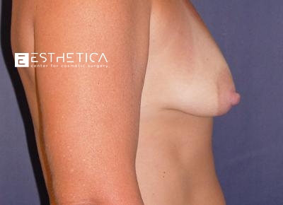 Breast Augmentation Before & After Patient #3223