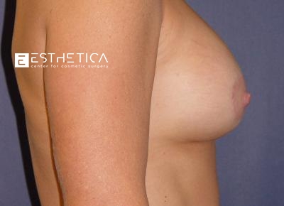 Breast Augmentation Before & After Patient #3223