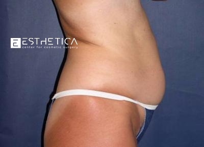 Liposuction Before & After Patient #3686
