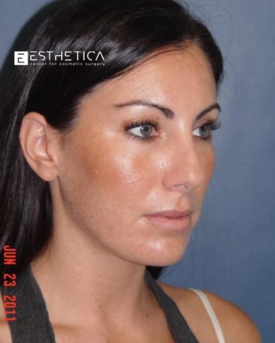 Rhinoplasty Before & After Patient #3143