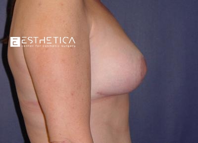 Breast Lift Before & After Patient #3479