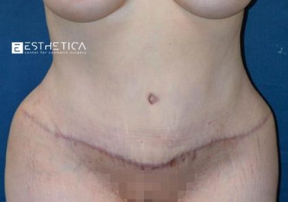 Tummy Tuck Before & After Patient #3632