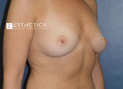 Breast Augmentation Before & After Patient #3230