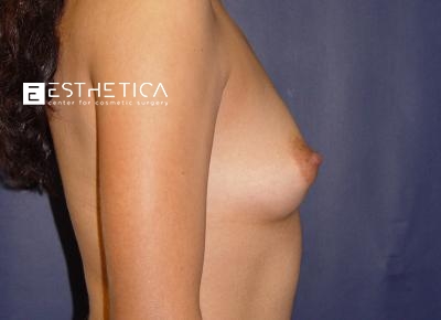 Breast Augmentation Before & After Patient #3335