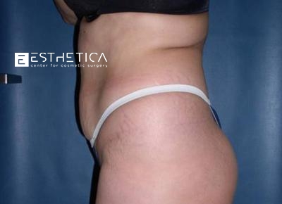 Liposuction Before & After Patient #3693