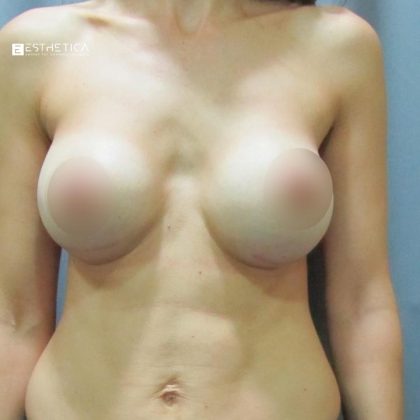 Breast Augmentation Before & After Patient #3443