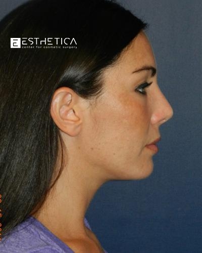 Rhinoplasty Before & After Patient #3143