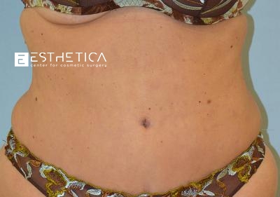 Liposuction Before & After Patient #3698