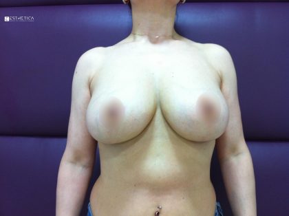Breast Lift Before & After Patient #3497