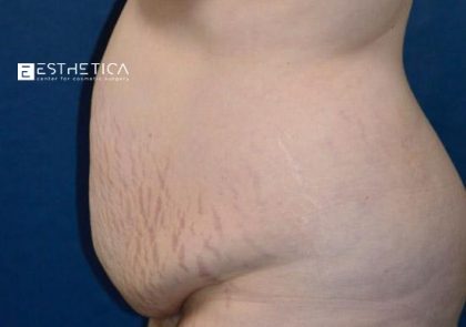 Tummy Tuck Before & After Patient #3632