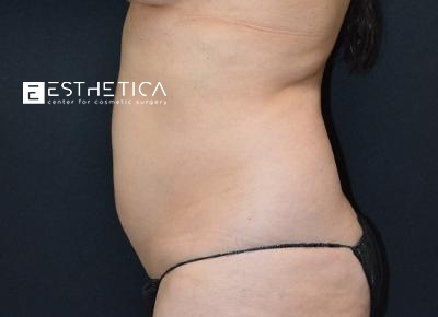Liposuction Before & After Patient #3658