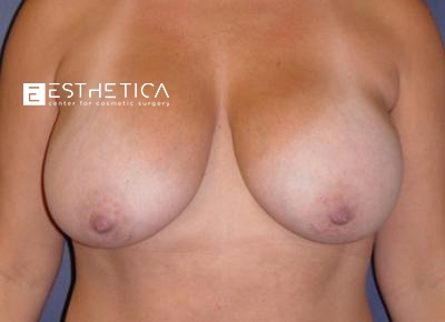 Breast Augmentation Before & After Patient #3248