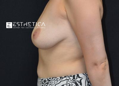 Breast Augmentation Before & After Patient #3349