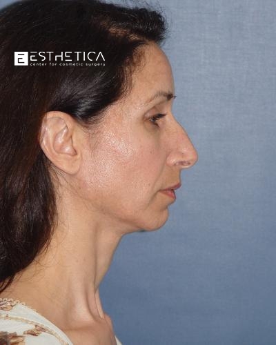 Rhinoplasty Before & After Patient #3163