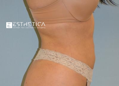 Liposuction Before & After Patient #3705
