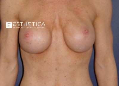 Breast Augmentation Before & After Patient #3255
