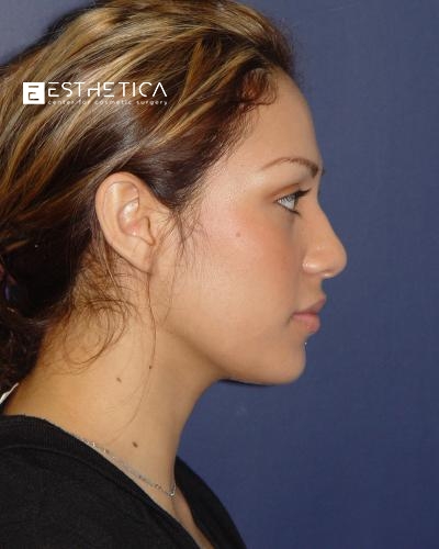 Rhinoplasty Before & After Patient #3170