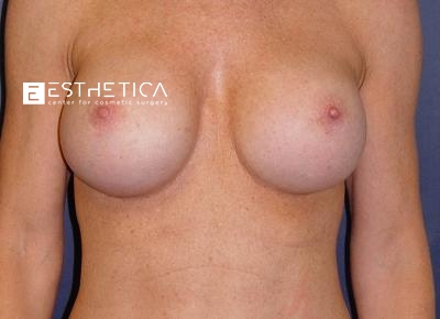 Breast Augmentation Before & After Patient #3255