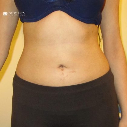 Liposuction Before & After Patient #3717