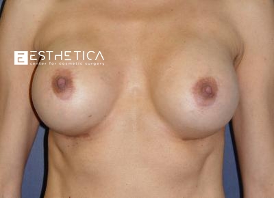 Breast Augmentation Before & After Patient #3370