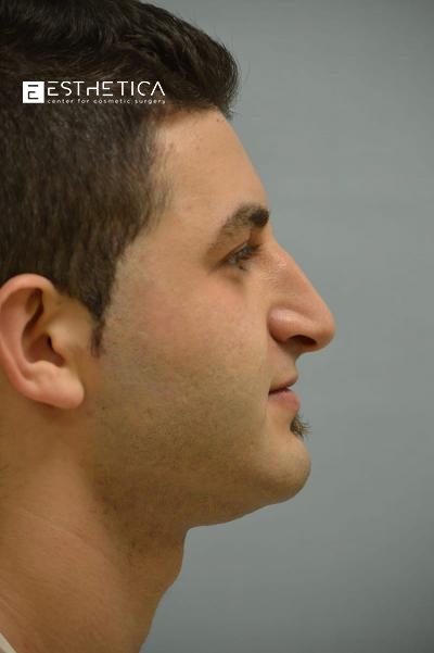 Rhinoplasty Before & After Patient #3554