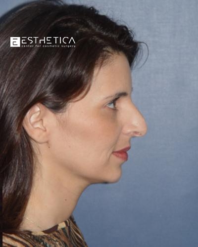 Rhinoplasty Before & After Patient #3118