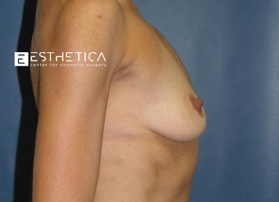 Breast Augmentation Before & After Patient #3370