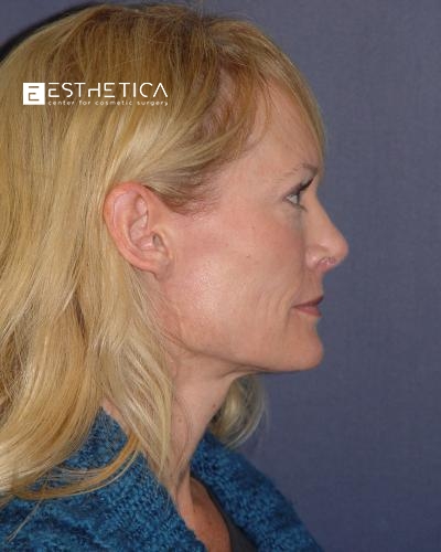 Rhinoplasty Before & After Patient #3184