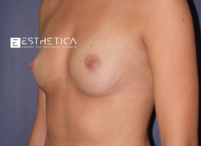 Breast Augmentation Before & After Patient #3375