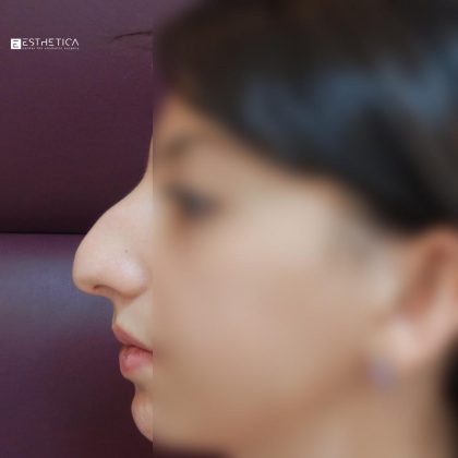 Rhinoplasty Before & After Patient #3191