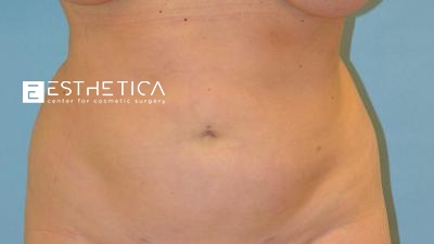 Liposuction Before & After Patient #3665