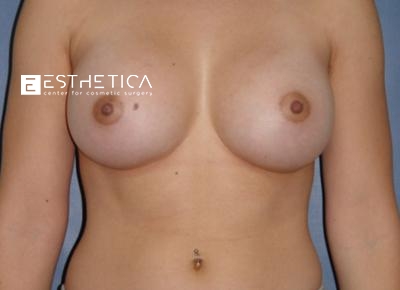 Breast Augmentation Before & After Patient #3309