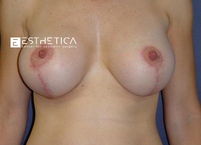 Breast Lift Before & After Patient #3458