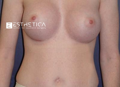 Breast Augmentation Before & After Patient #3280