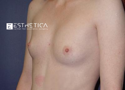 Breast Augmentation Before & After Patient #3280