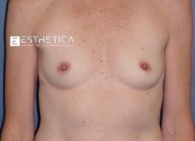 Breast Augmentation Before & After Patient #3413