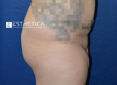 Liposuction Before & After Patient #3599