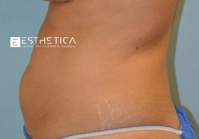Tummy Tuck Before & After Patient #3637