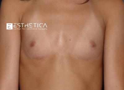 Breast Augmentation Before & After Patient #3302