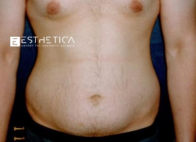 Liposuction Before & After Patient #3525