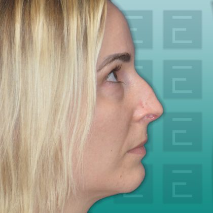 Rhinoplasty Before & After Patient #4153