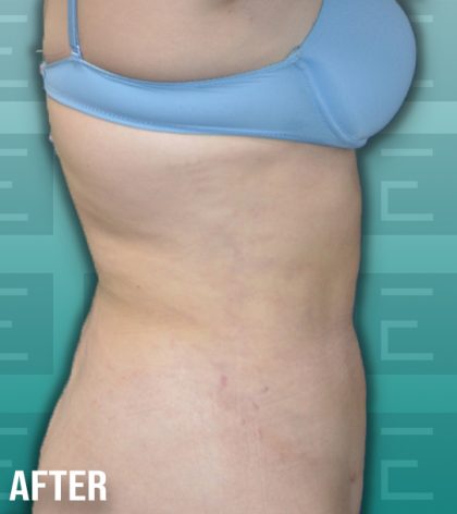 Liposuction Before & After Patient #4192