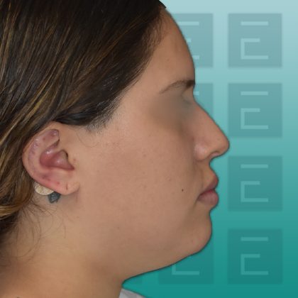Rhinoplasty Before & After Patient #4176